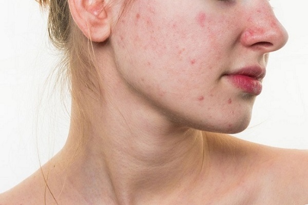 Những nguy cơ tiềm ẩn khiến da nổi mụn